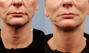 RF Microneedling