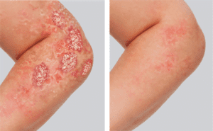 Psoriasis