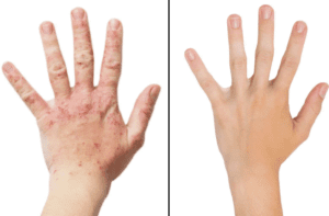 Eczema