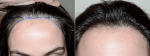 Hair Transplant