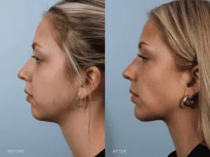 Hero Jawline Treatments