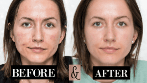 Microneedling