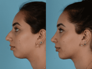 Nose Surgery