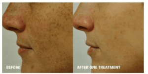 Pigmentation Treatment