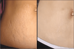 Stretch Marks Treatments