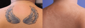 Tattoo Removal Laser